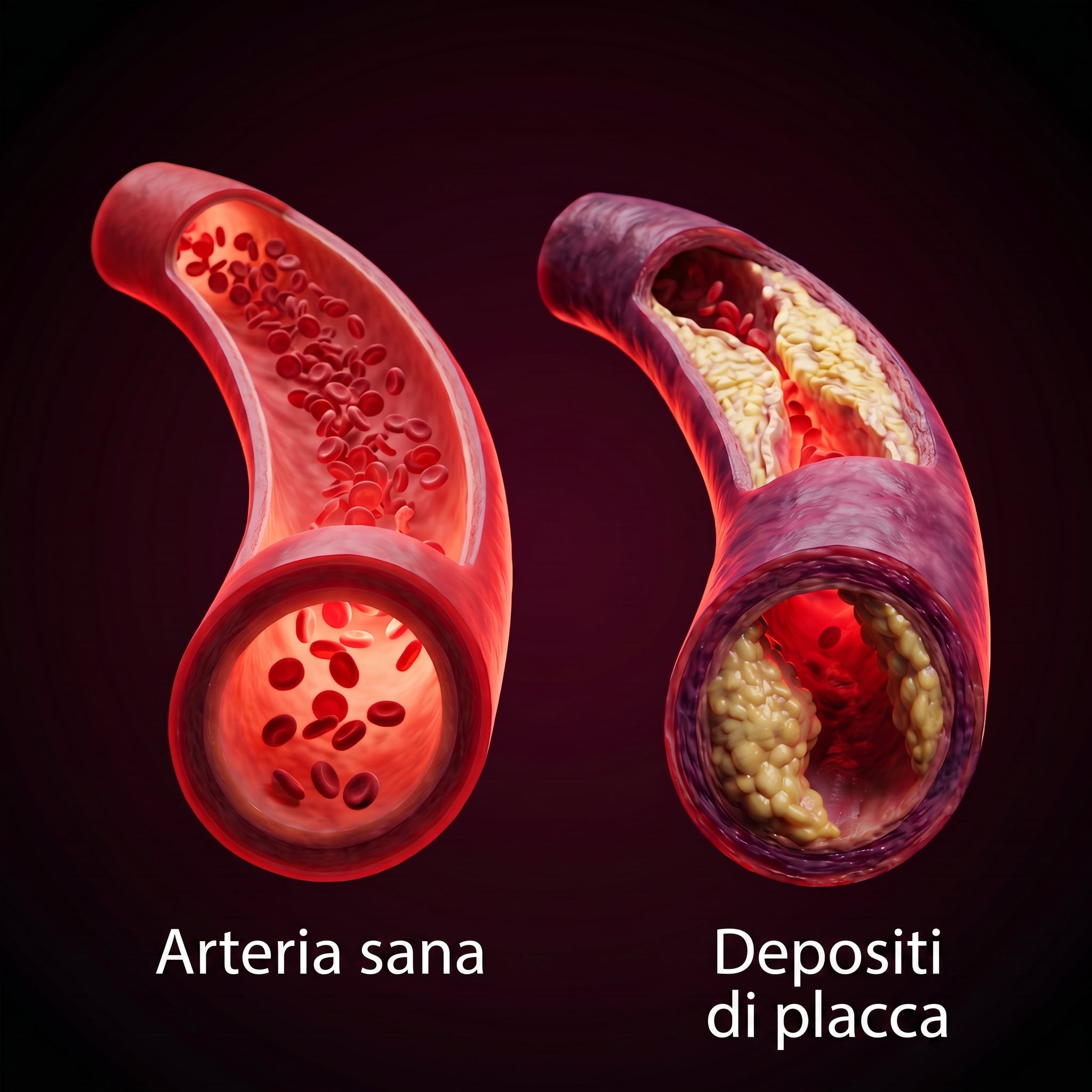 Arteria sana a confronto con un'arteria con depositi di placca Immagine
